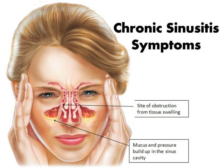 Chronic Sinusitis Symptoms And Treatments 9125