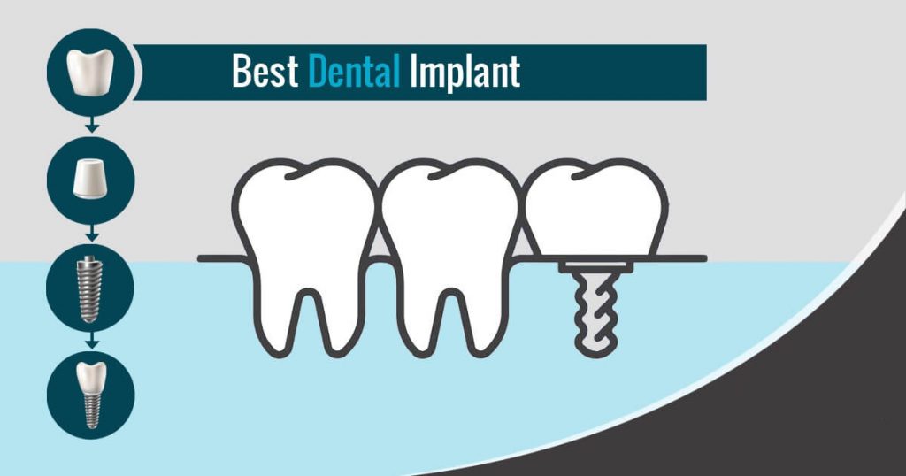 dental implant