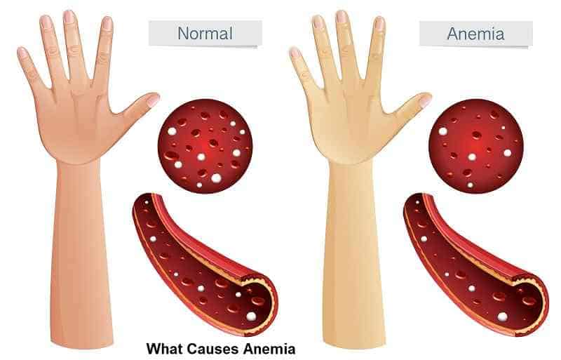 What Causes Anemia