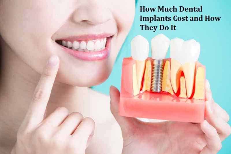 How Much Dental Implants Cost and How They Do It