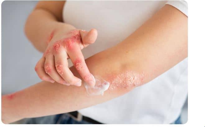 How Can Eczema Be Managed Through Lifestyle and Care?